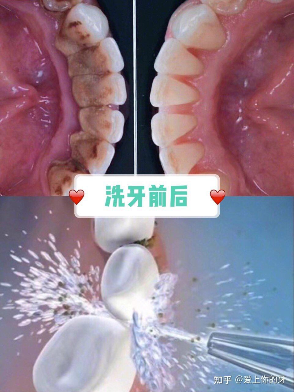 巴中洗牙可以用医保吗(洗牙可以用医保吗,报销比例多少)